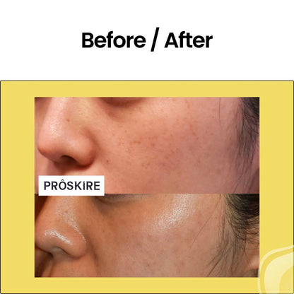 PROSKIRE 10% VITAMIN C FACE SERUM